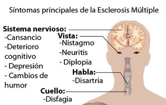 Esclerosis Aserga